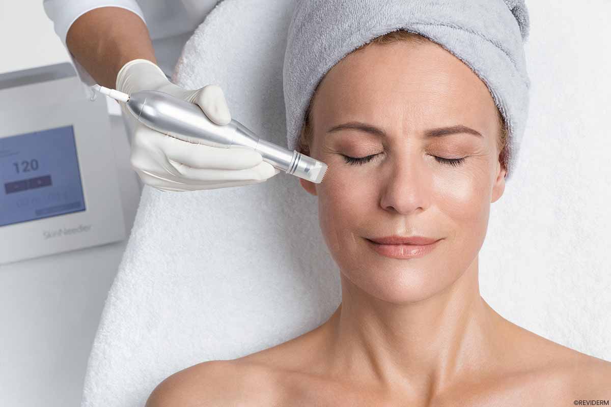 microneedling my beauty spa
